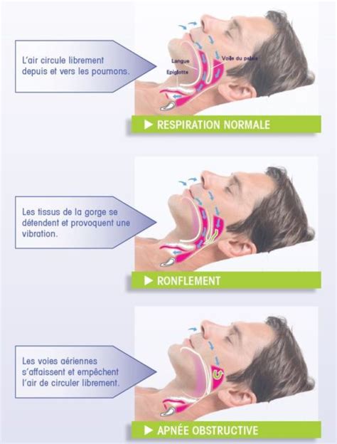 ppc deped|traitement de l'apnée du sommeil.